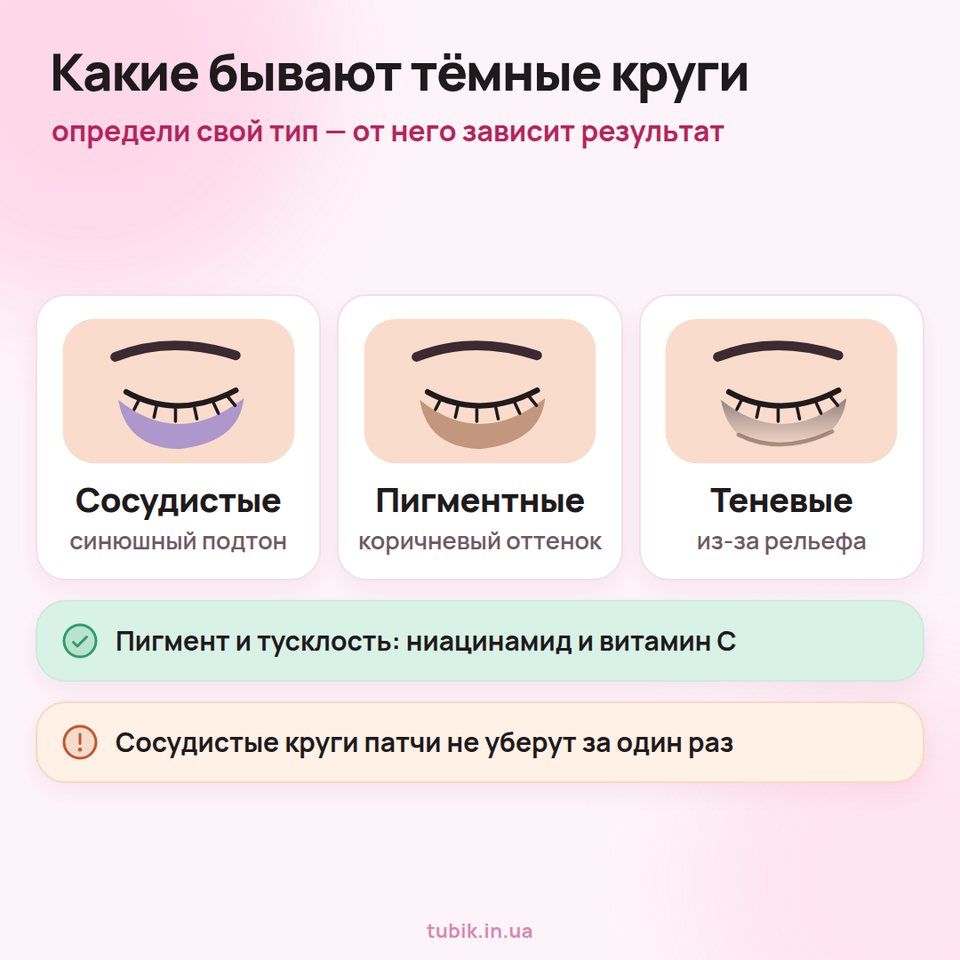Три типа тёмных кругов под глазами: сосудистые (синюшный подтон), пигментные (коричневый оттенок) и теневые (из-за рельефа)